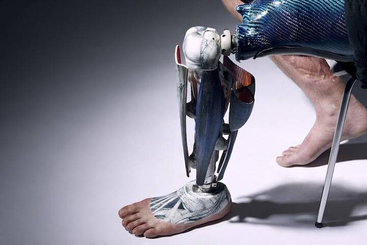 Бионические протезы ног