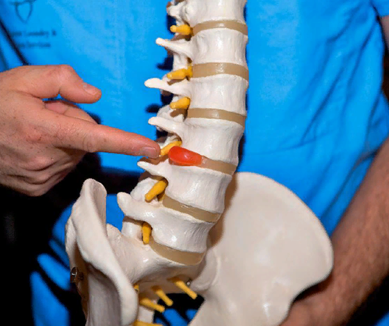 На изображении грыжа межпозвонкового диска