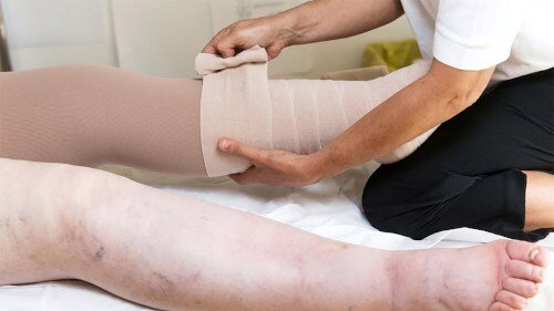 Лимфедема - диагностирование и лечение | Экспертная флебология | Дзен