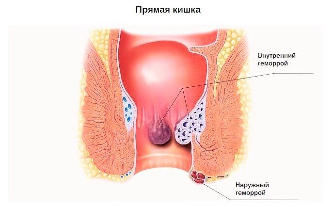 Болезненные ощущения вызывают, как правило, наружные геморроидальные узлы