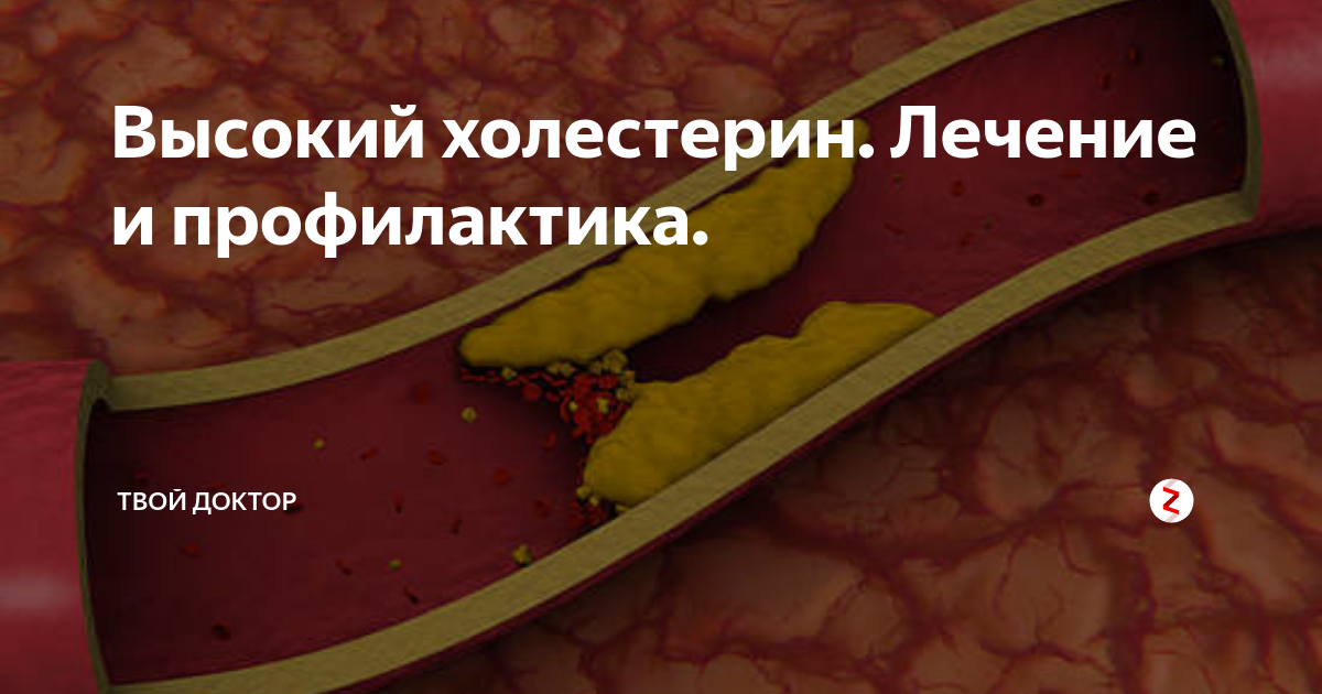 Синдром холестерина. Холестерин. Холестерин в крови. Холестерин повышен. Причины высокого холестерина