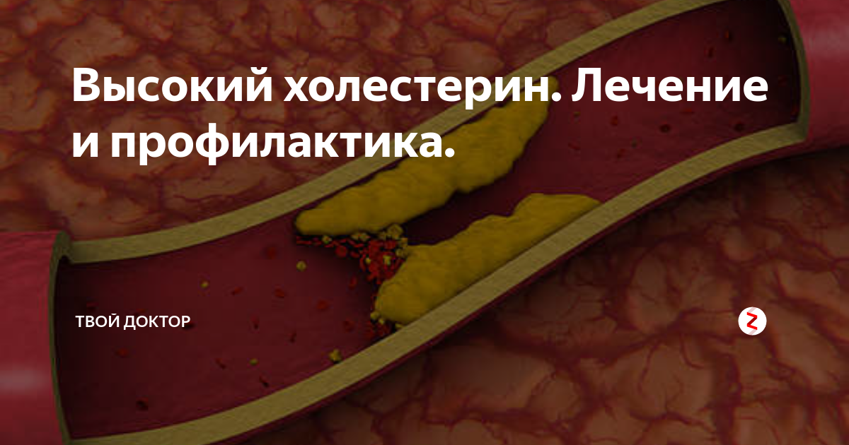 Лечение холестерина. Высокий холестерин. Мифы о холестерине. Болезни повышенного холестерина. Холестерин при диабете 2.