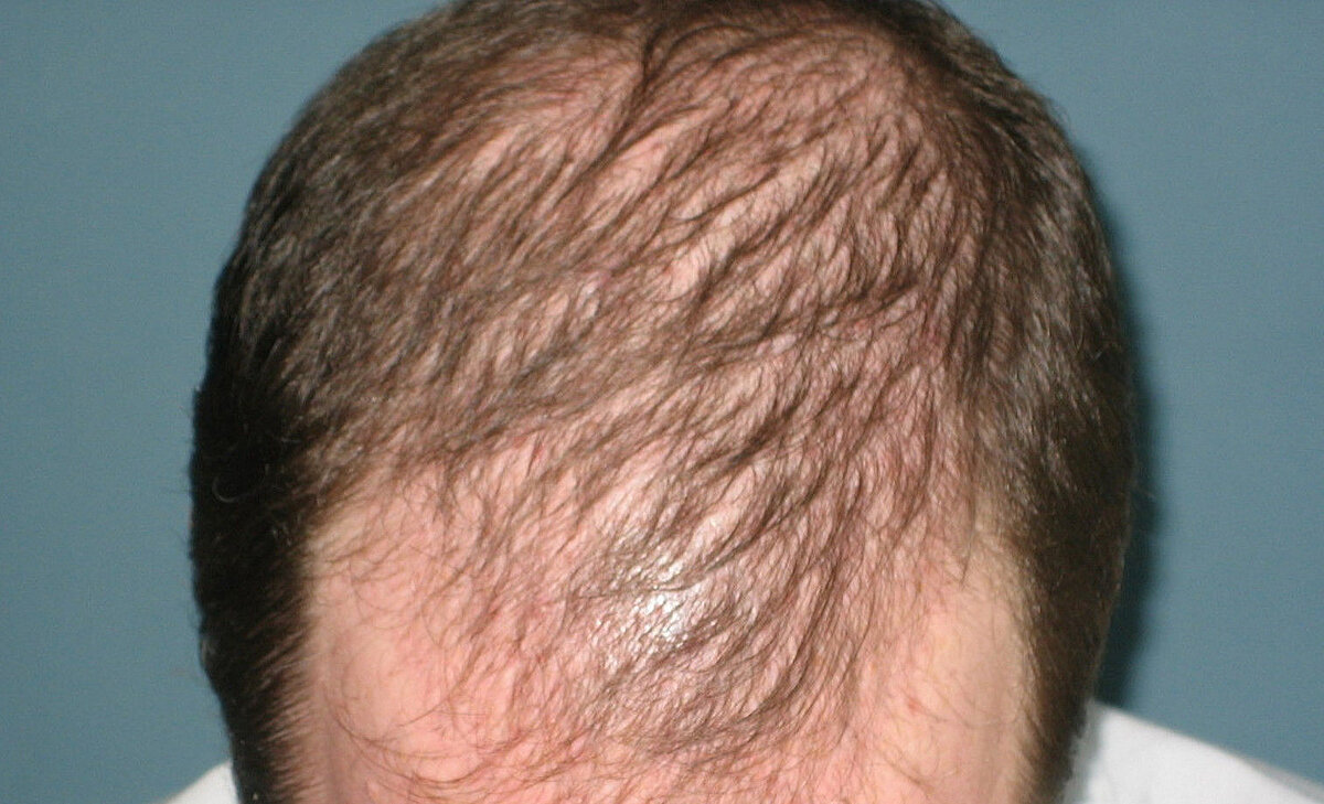 Выпадают волосы на макушке. Очаговая алопеция (alopecia Areata). Гиперандрогенная алопеция. Андрогенная алопеция мкб 10. Андрогенная алопеция алопеция.