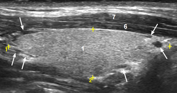 Продольный ультразвуковой срез доли щитовидной железы