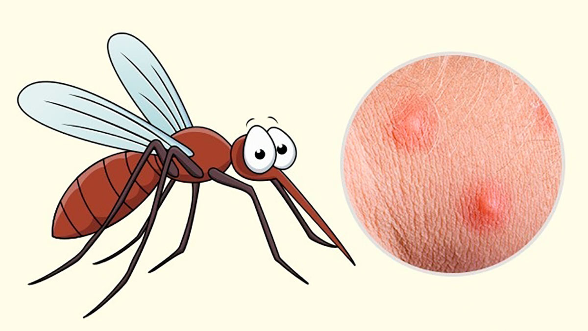 Что делать если укусил комар или другое насекомое: пчела, шмель, оса, шершень