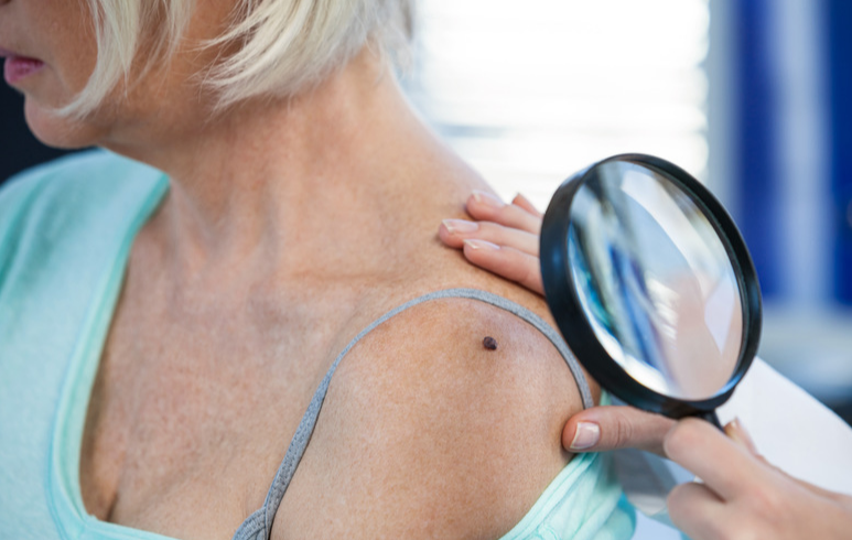 Темная родинка с изменяющейся формой-это самая распространенная форма меланомы