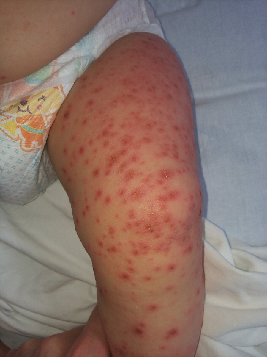 Сыпь при энтеровирусной инфекции (из личного архива автора канала)