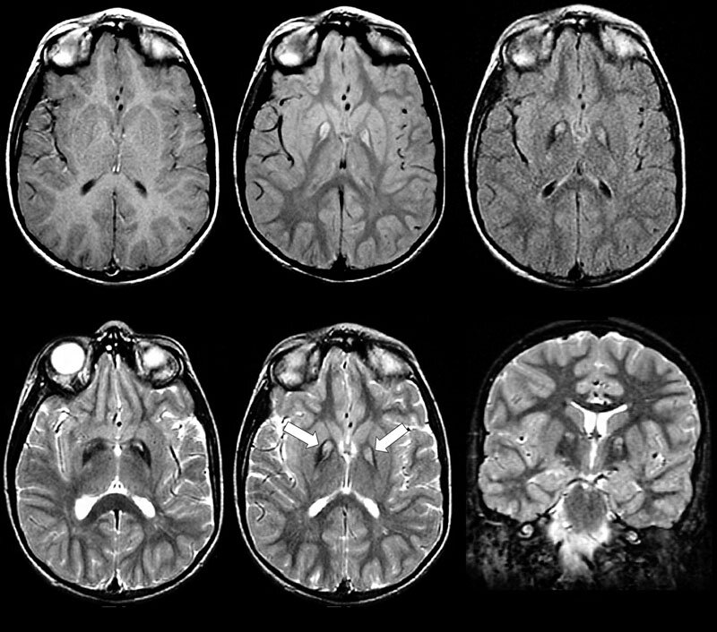 МРТ головного мозга. Источник: vsemrt.ru