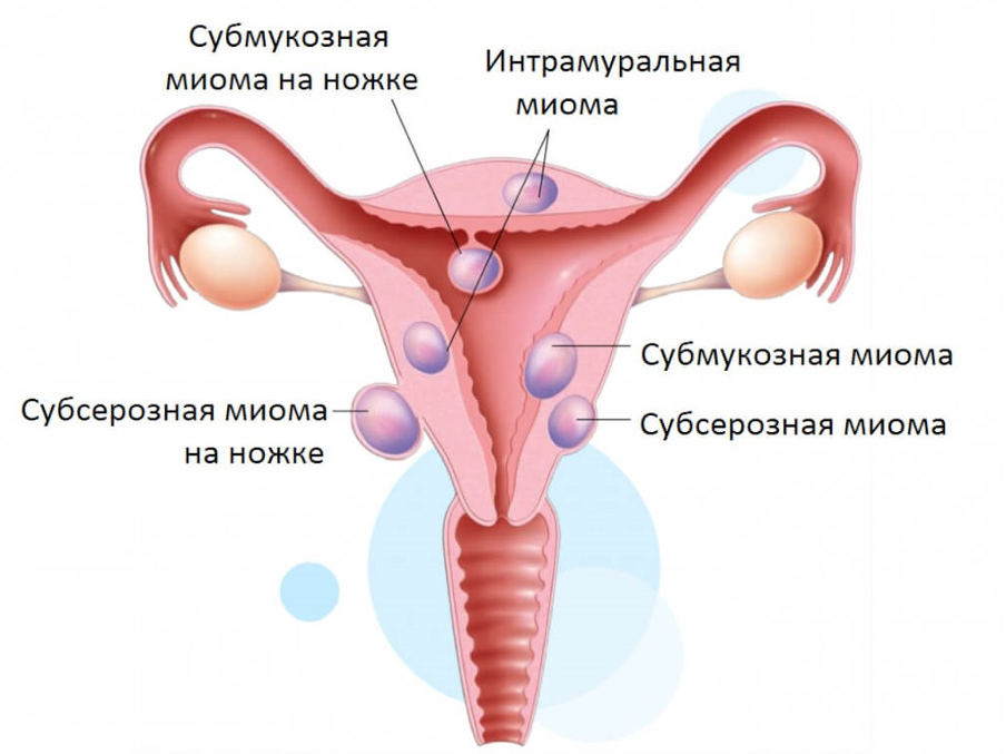 Беременность при миоме