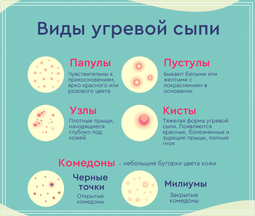 Виды угревой сыпи