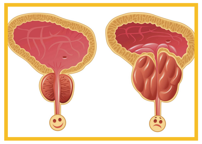 Простатит