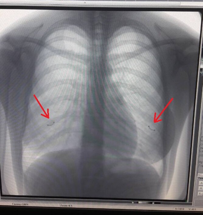 Видно ли на флюорографии. Рентген ребер грудной клетки норма. Аномалии ребер рентген. Флюорография перелом ребра. Снимки флюорографии.