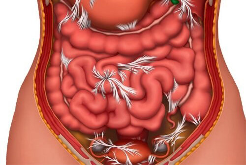 Спаечная болезнь
