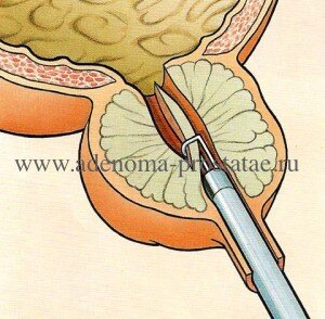     картинка с сайта www,adenoma-prostatae.ru
