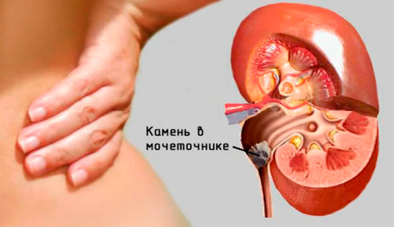 Камни в почках