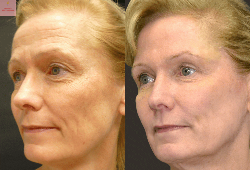 До и После использования витаминов