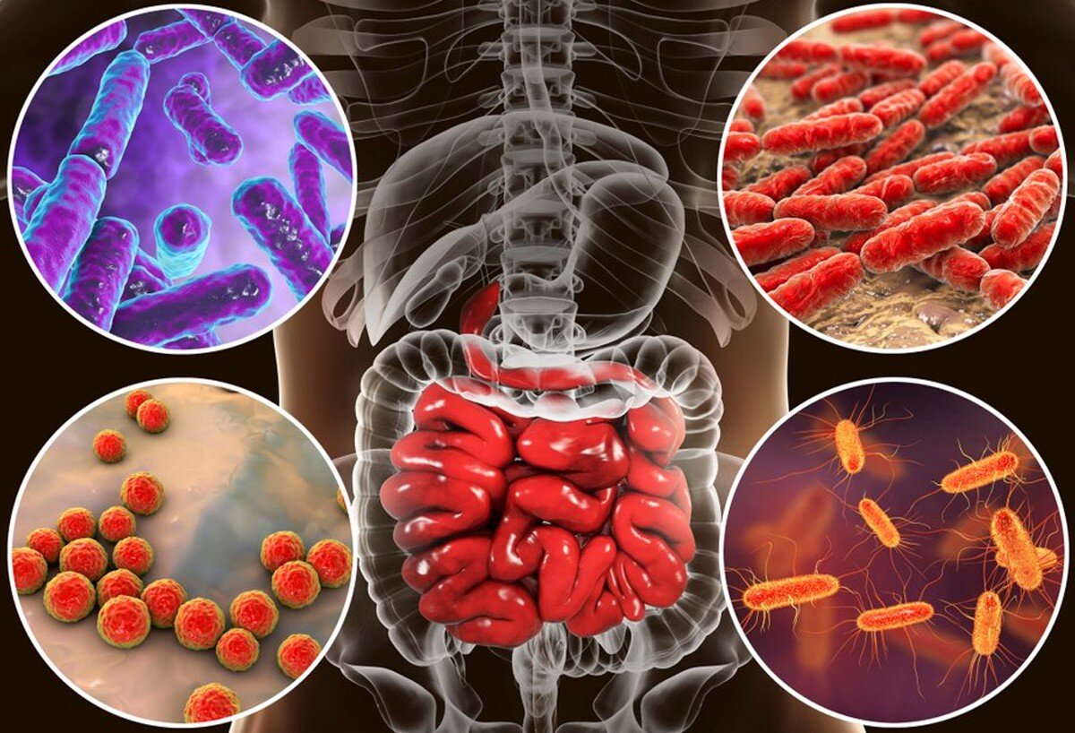 Pseudomembranous colitis