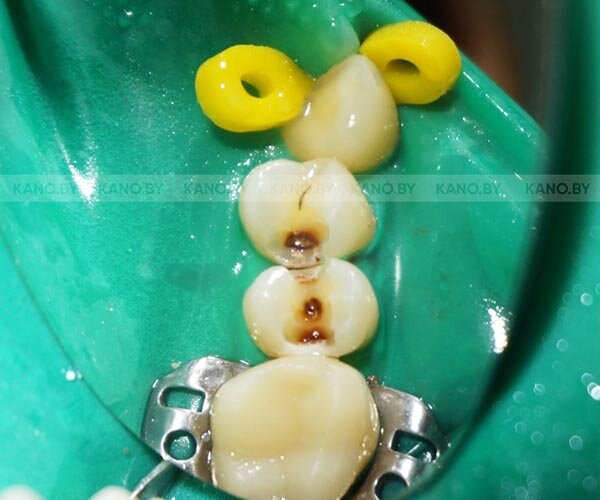 Так изнутри выглядит контактный кариес