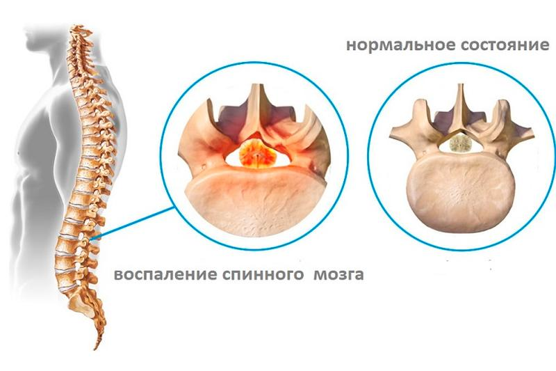 Воспаление позвоночника. Инфекционный поперечный миелит. Миелит позвоночника. Поперечный миелит спинного. Острый поперечный миелит спинного мозга.