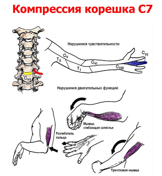Последствия грыжи шейного отдела