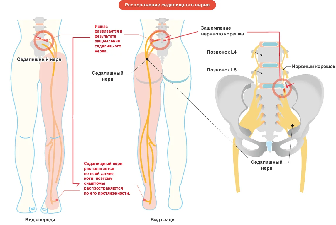 На что обратить внимание при ишиасе? | International Lumbago Clinic | Дзен