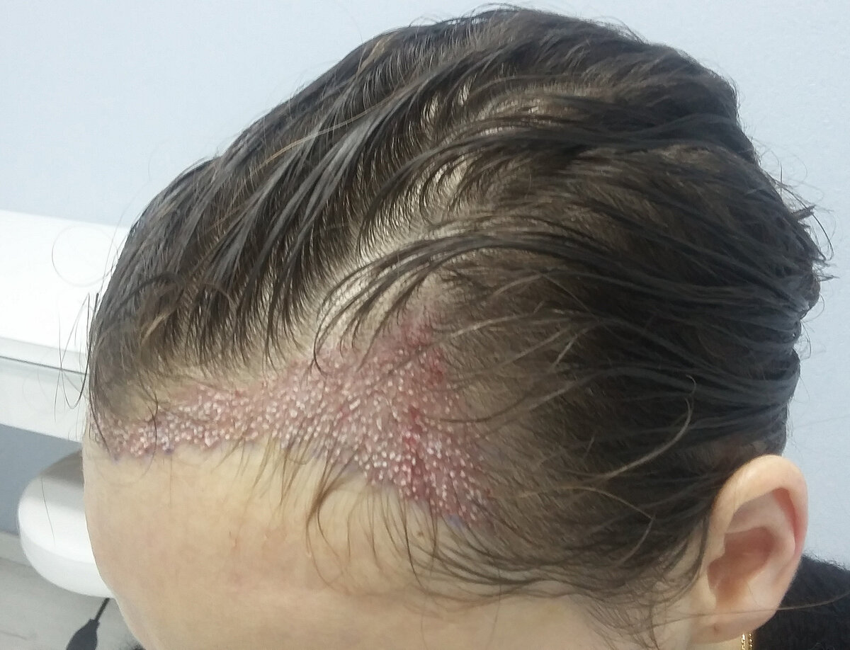 Пересадка волос у женщин (лобные треугольники)