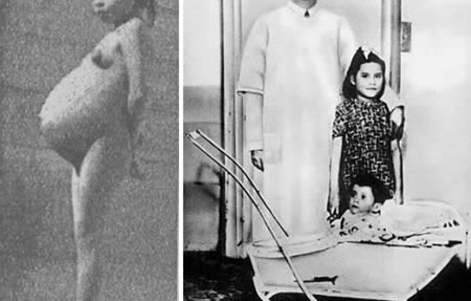 Лина Медина родился в Перу в 1933 году. Она родила ребёнка, когда ей было 5 лет, 7 месяцев и 21 день. Это мировой рекорд, по праву попавший в книгу рекордов Гинесса[/b] Родители привели Лиину в больницу, когда девочке не было еще 5-и лет, они переживали из - за увеличения брюшной полости у девочки. Первоначально и врачи, и родители предполагали опухоль. Но вскоре поняли, что ошибались, Лиина забеременела – она была уже на 7-м месяце беременности. Доктор Херардо Лозадо взял девочку в Лиму, столицу Перу, чтобы более квалифицированные врачи подтвердили диагноз. Дальнейшие исследования показали сердцебиение плода, а рентген окончательно подтвердил беременность.
Месяц спустя Лиина родила ребенка с помощью кесарева сечения. Сын родился «богатырем» - вес 5,9 кг. Его назвали в честь лечащего доктора – Херардо. До десяти лет Херардо считал Лиину своей сестрой. Потом ему все рассказали. Он рос здоровым ребенком, но в возрасте 40 лет в 1979 году умер, от рака костного мозга. 