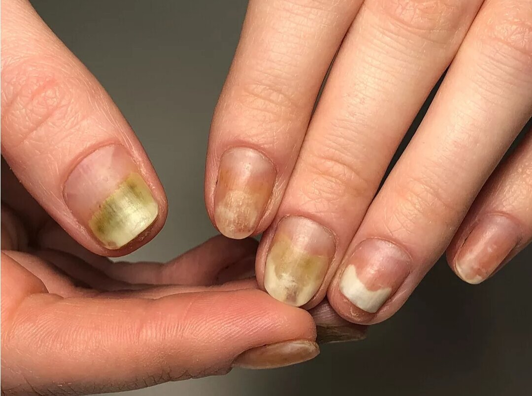 Обработка ногтей при грибковом поражении (онихомикозе)