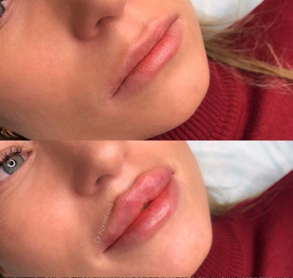 фото: Instagram dr.lips.spb 