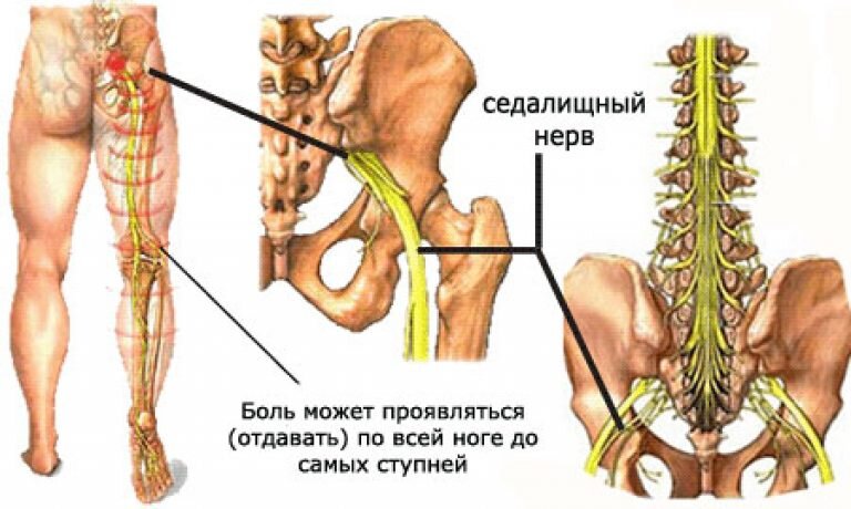 Тазовая невралгия - защемление нерва в тазобедренном суставе