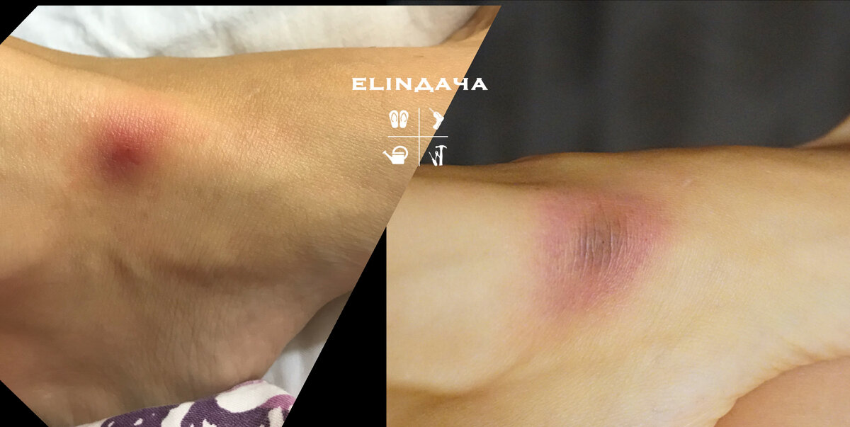 Эритема примерно 2 недели после укуса и еще через неделю. 
