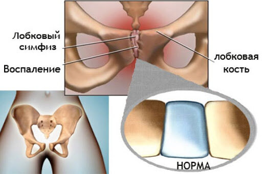 ᐈ Симфизит ~【Симптомы, причины, лечение в Киеве】