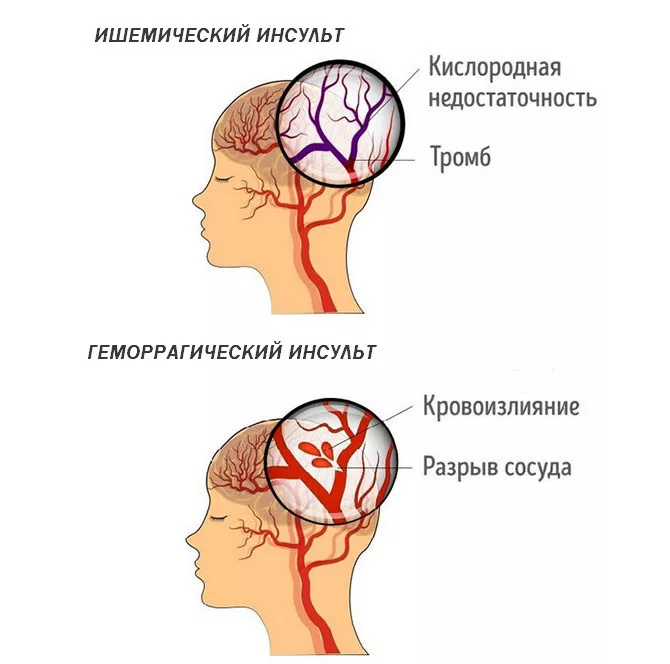 Где находится инсульт