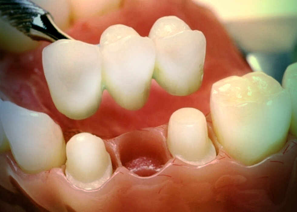 Как делают мосты зубов
