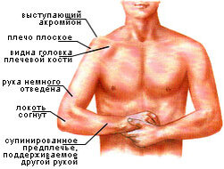 Вывих плеча: правильное лечение и реабилитация