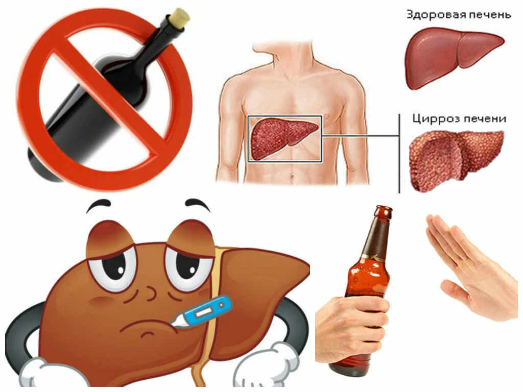 Лечение алкогольного цирроза печени. Алкогольный гепатит и цирроз. Алкогольные заболевания печени. Профилактика алкогольного гепатита.