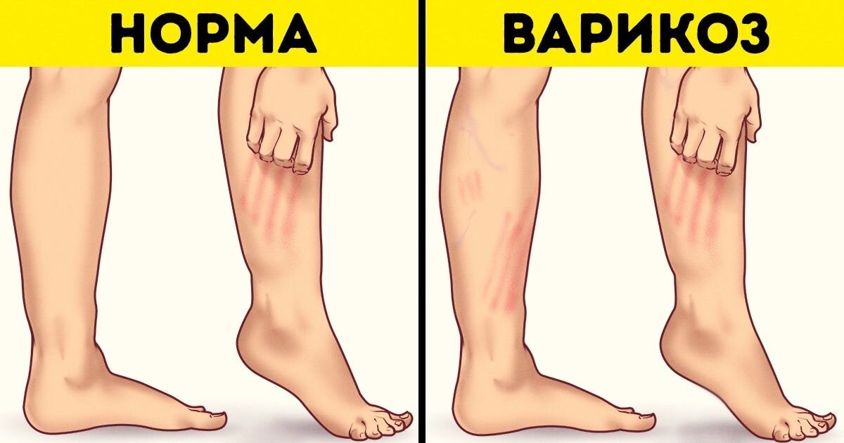 Варикоз малого таза. % лечение | Экспертная флебология