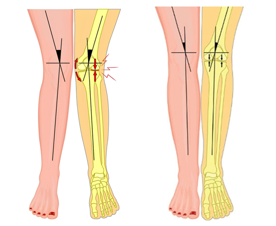 Варусная деформация коленных суставов у взрослых