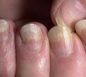 Если у Вас грибок ногтей проходите осмотр у врача дерматолога не реже 1 раза в месяц