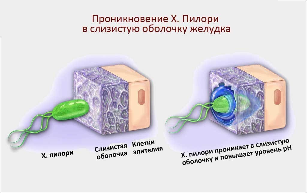 Хеликобактер пилори в Екатеринбурге - Новая больница