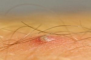 Если вросшие волоски расположены на поверхности и нет воспаления, то нужно распарить кожу и выполнить легкий пилинг или обработать ее жесткой мочалкой или губкой.