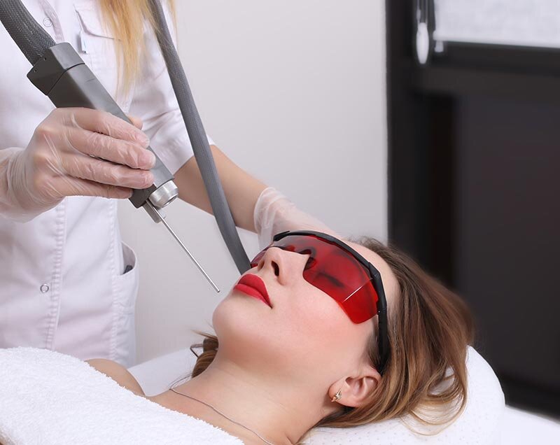 Лазерная эпиляция