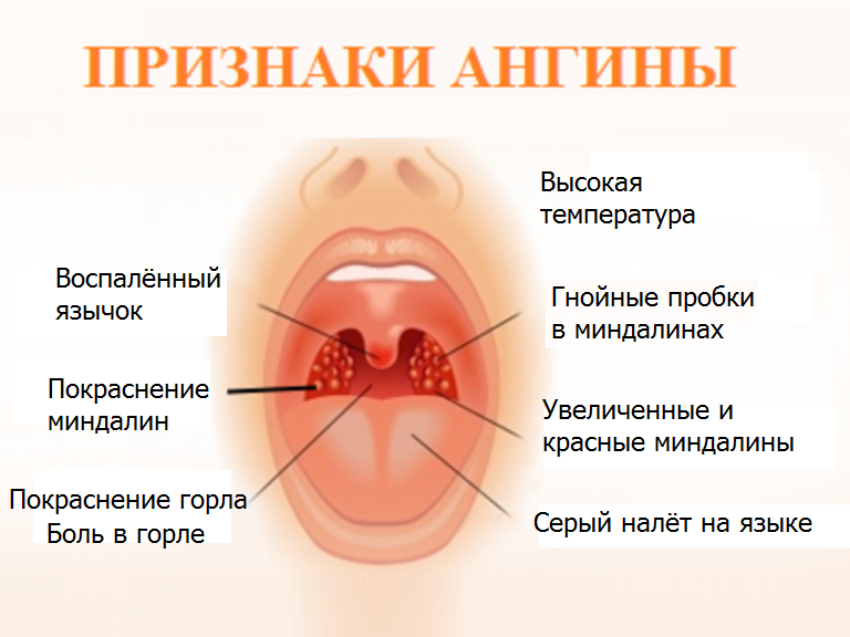 2 маленький язык. Стрептококковая ангина. Гнойное воспаление миндалин