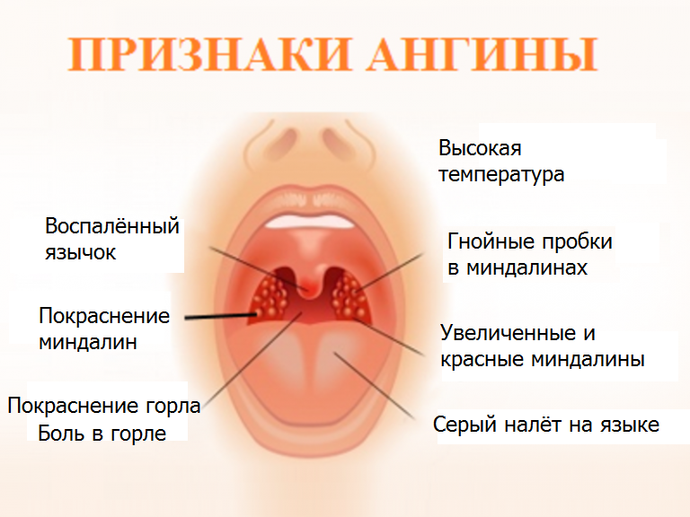 Стрептококковая ангина. Гнойное воспаление миндалин.