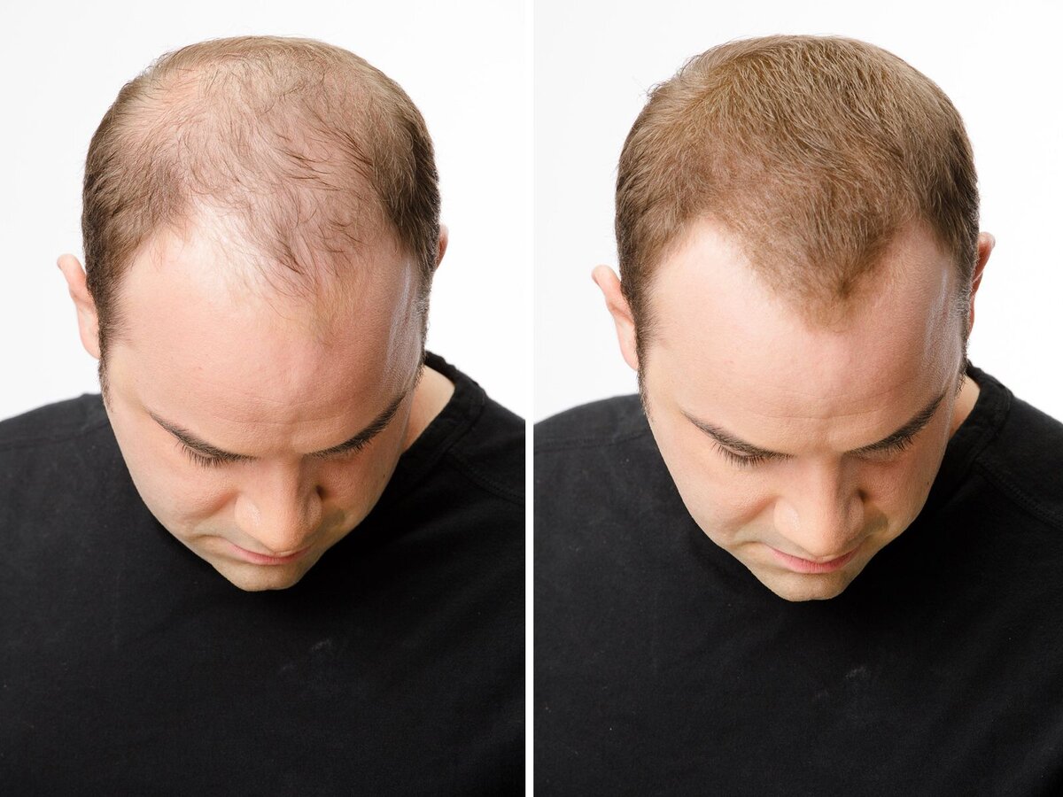 прически с лысиной на затылке.