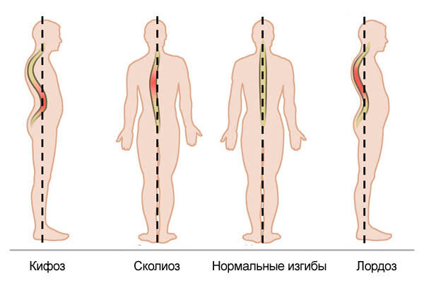 Срыв спины: симптомы, диагностика и методы лечения