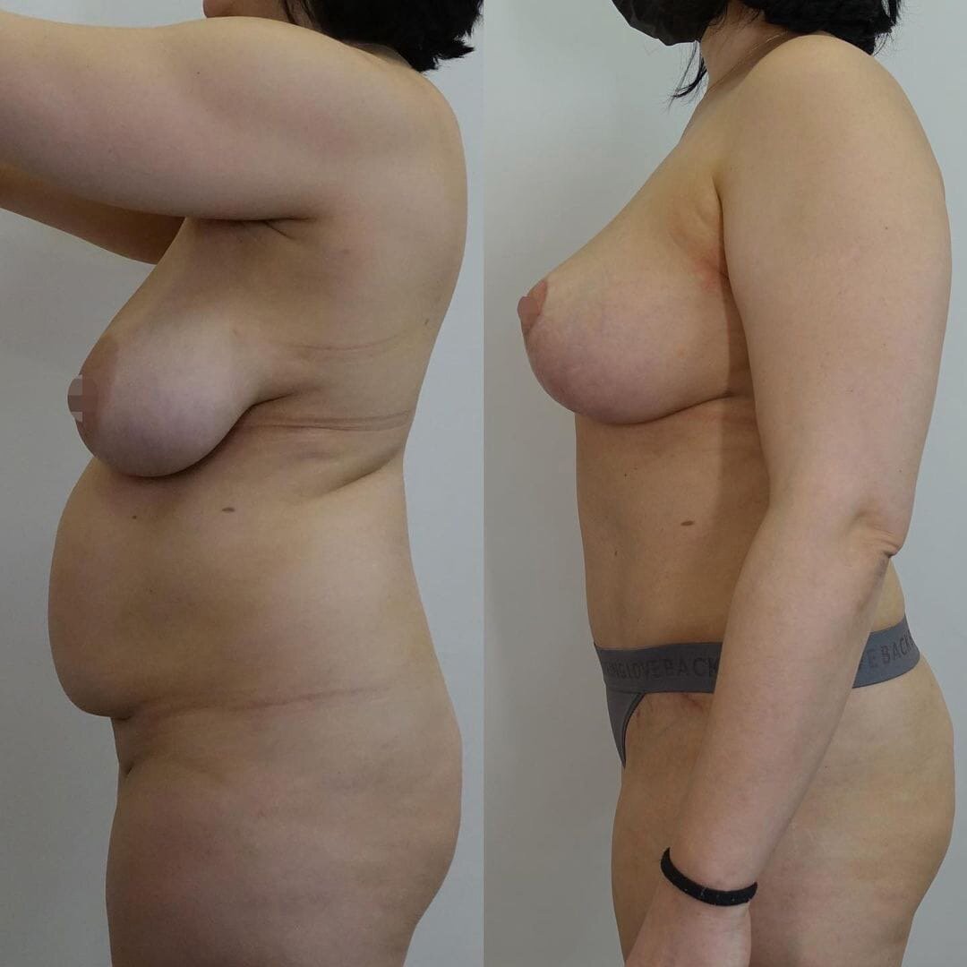 липосакции груди у женщин фото 34