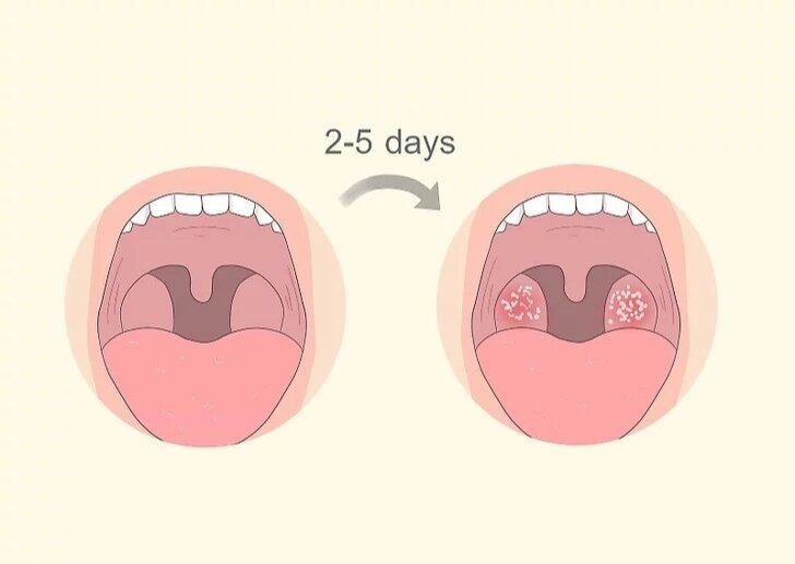 Хронический тонзиллит - это  последствия острого тонзиллита (ангины).