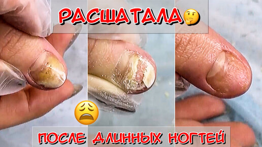 Расшатала ноготь до онихолизиса😫😱 Чем опасны длинные ногти? / Маникюр / Подология