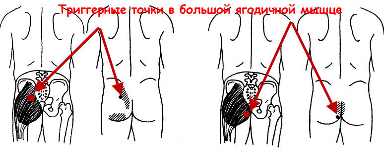 Как быстро снять боль в ягодице
